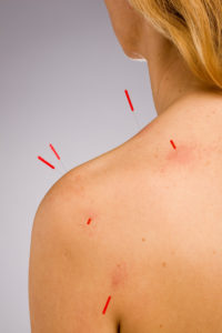 Woman receiving acupuncture treatment to shoulder