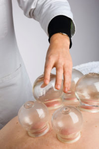 Acupuncturist performs vacuum cupping on patients back